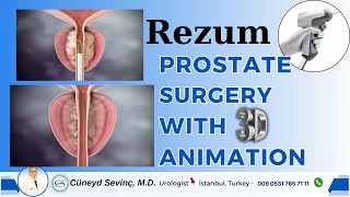 Rezum Prostate Surgery with 3D Animation [upl. by Ridinger]