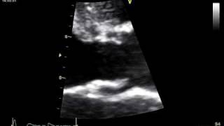 ASBCESS  ACUTE AORTIC REGURGITATION [upl. by Christenson]