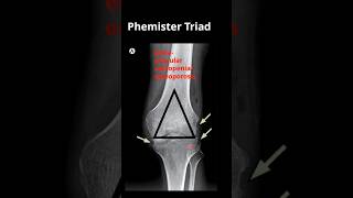 Phemister Triad  Tuberculous arthropathy [upl. by Acirretal]