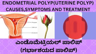 ENDOMETRIAL POLYPUTERUS POLYP CAUSES SYMPTOMS TREATMENT IN KANNADAINFERTILITY ENDOMETRIAL POLYP [upl. by Cohlier]