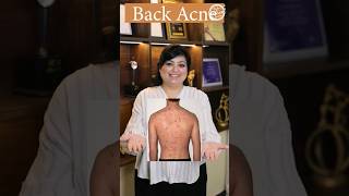 How to get rid of back acne  Back acne treatment  Lacne Body Spray  Best dermatologist in Delhi [upl. by Eiramait]