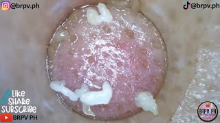 PORE VACUUM BLACKHEAD REMOVAL DEMO FOR Week32 CLASSICAL MUSIC brpvph​satisfying [upl. by Stoeber935]