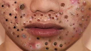 Big Cystic Acne Blackheads Extraction Blackheads amp Milia Whiteheads Removal Pimple Popping  5352 [upl. by Qirat]