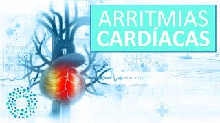 ARRITMIAS CARDIACAS – Síntomas y Tratamientos Arritmias [upl. by Aleuqahs]