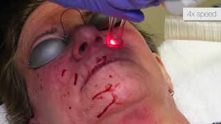 Total FX CO2 Laser Resurfacing  Full Face [upl. by Molini]