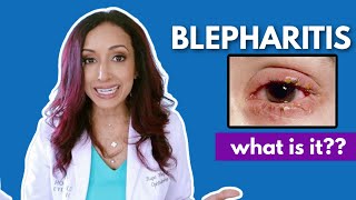 What Is Blepharitis Eye Doctor Explains [upl. by Assirual]