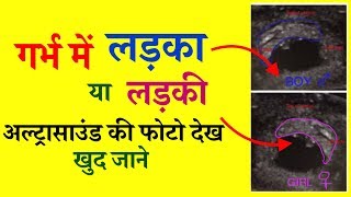 Baby Boy Pregnancy Symptoms From Ramzi Theory Ultrasound  Garbh me ladka ya ladki kaise jane [upl. by Yeniffit]