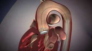 TAVR Edwards Sapien Aortic Valve Deployment [upl. by Eatnahs]