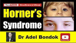 Horners Syndrome Dr Adel Bondok Making Anatomy Easy [upl. by Anwadal]