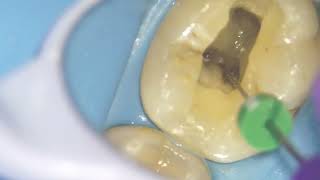 Management of cracked tooth [upl. by Assert]