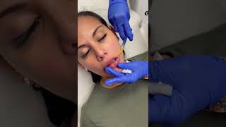 Lip filler cannula technique [upl. by Anez]