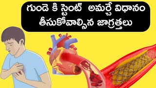 Heart stent గుండెలో స్టెంట్ అమర్చే విధానం [upl. by Ugo817]