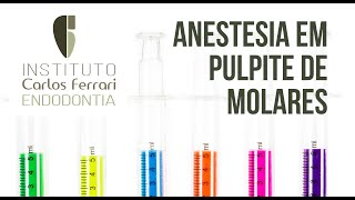 Anestesia em pulpite de molares [upl. by Amleht226]