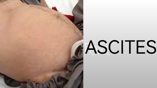 Ascites II Grades of Ascites II Treatment of Ascites II DrKhalil [upl. by Llehcram]