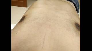 Immediate PostOp Revision Gynecomastia Vaser HIDef PowerX Liposculpture by Dr Lebowitz NY [upl. by Averyl]