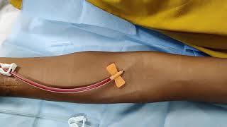 First time Cannulation of AV Fistula [upl. by Hoban]