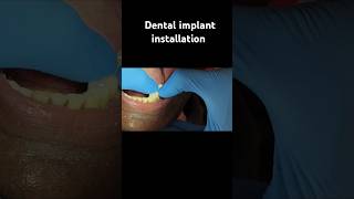 All on 4 implantdentist dentalclinic teeth tooth ytshorts insiderscraft [upl. by Ahcirt139]