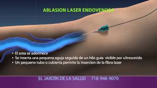 Animation of Ablación Laser Endovenosa [upl. by Aridaj]