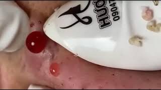 Pimple Pop Part 2 [upl. by Cooper4]