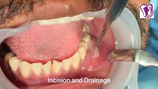 Incision and Drainage of Tooth Abscess Draining Pus [upl. by Hadeehuat]