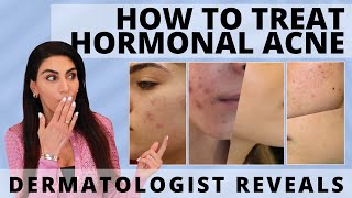 Dermatologist Unveils How to Treat Hormonal Acne  acne acnetreatment hormonalacne [upl. by Veronica]