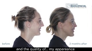 ALICJA Biretrusion  Bimaxillary Orthognatic Surgery with Surgery First Protocol [upl. by Seed]