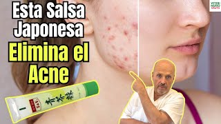 😱COMO ELIMINAR EL ACNE EN LA PIEL CON WASABI😱 [upl. by Avelin]