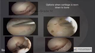 Treatment Options When Cartilage Is Worn Down to Bone [upl. by Shaer707]