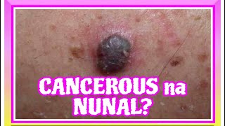 CANCEROUS na Nunal Alaman ang mga itsura mole medical cancer facts treatment [upl. by Bates]