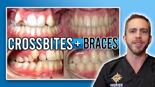 Braces Before and After The Power of Orthodontics orthodontic Before after orthodontist Brace [upl. by Oluas]