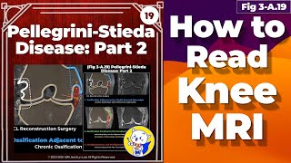 Fig 3A19 PellegriniStieda Disease Part 2 [upl. by Anivle674]