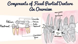 Fixed Partial Denture Components Advantages Objectives Retainer Pontic Connector FPD vs RPD [upl. by Berkley905]