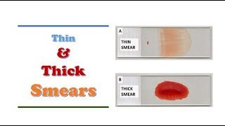 Hematology 🔤  Thin and Thick Blood Films [upl. by Gnuhp979]