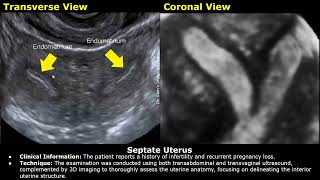 Congenital Uterine Anomalies Ultrasound Reporting  Didelphys Bicornuate Unicornuate Uterus USG [upl. by Tiffi357]