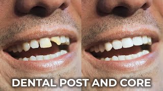 Post and Core  The Key to Durable Dental Restorations [upl. by Htebirol]