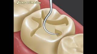 asmr so satisfying Caries Removal animationDental careCaries restorationAsmr animation05 [upl. by Kellyn]