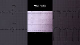 Atrial Flutter ECG Examples [upl. by Eamaj]