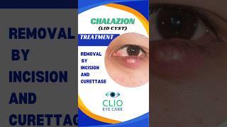 Chalazion Treatment Incision and Curettage  CLIO Eye Care [upl. by Bough]