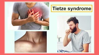 Tietze syndrome [upl. by Ferrick703]