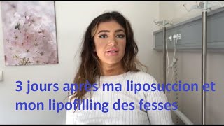 Chirurgie esthétique Tunisie – Liposuccion et lipofilling des fesses avec Chirurgiedirect [upl. by Hollerman]