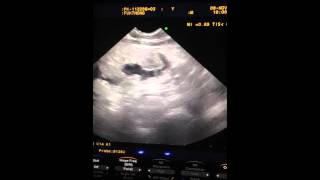 Ultrasound  bladder mass Transitional cell carcinoma [upl. by Anairad396]