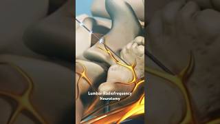 Lumbar Radiofrequency Neurotomy [upl. by Aikemaj]