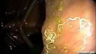 Worms parasites In the Human Intestinal Tract [upl. by Elmaleh]