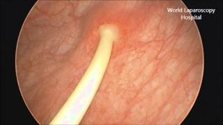 Removal of Double J stent by Cystoscopy [upl. by Eidnew]