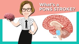 Pons Stroke [upl. by Aeli700]