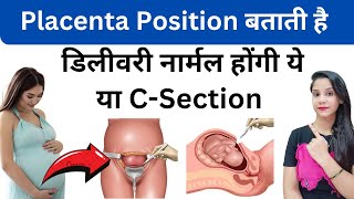 प्लेसेटा पोजीशन से जाने की डिलीवरी नार्मल होंगी या CSection  Placenta Position During Pregnancy [upl. by Margette]