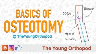 Basics of Osteotomy [upl. by Arleta352]