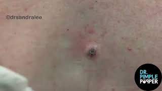 8 MINUTES OF SATISFYING POPS with Dr Sandra Lee  Dr Pimple Popper [upl. by Ernest]