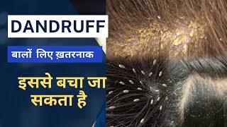 Dandruff ko kaise hataye  dandruff treatment dandruff [upl. by Inerney]