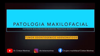 TUMOR ODONTOGENICO ADENOMATOIDE [upl. by Sillig683]